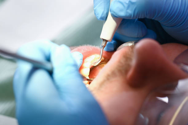 Best Emergency Dentist for Knocked-Out Tooth in Lake Worth, TX
